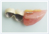 リーゲルテレスコープ義歯